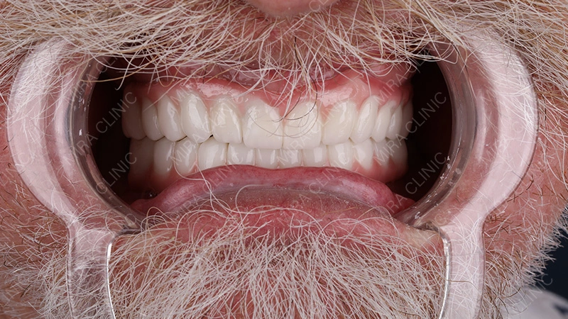 Adjusting to a New Smile